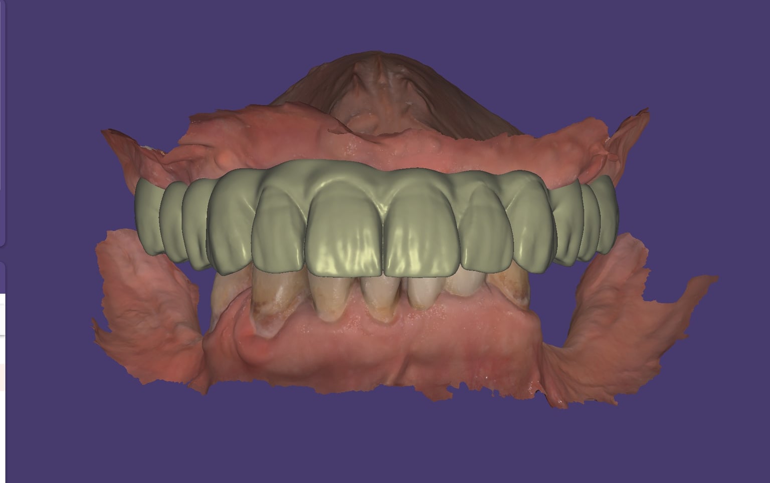 Digitales Smile-Design eines Zahnbogens auf dem Scanmodell
