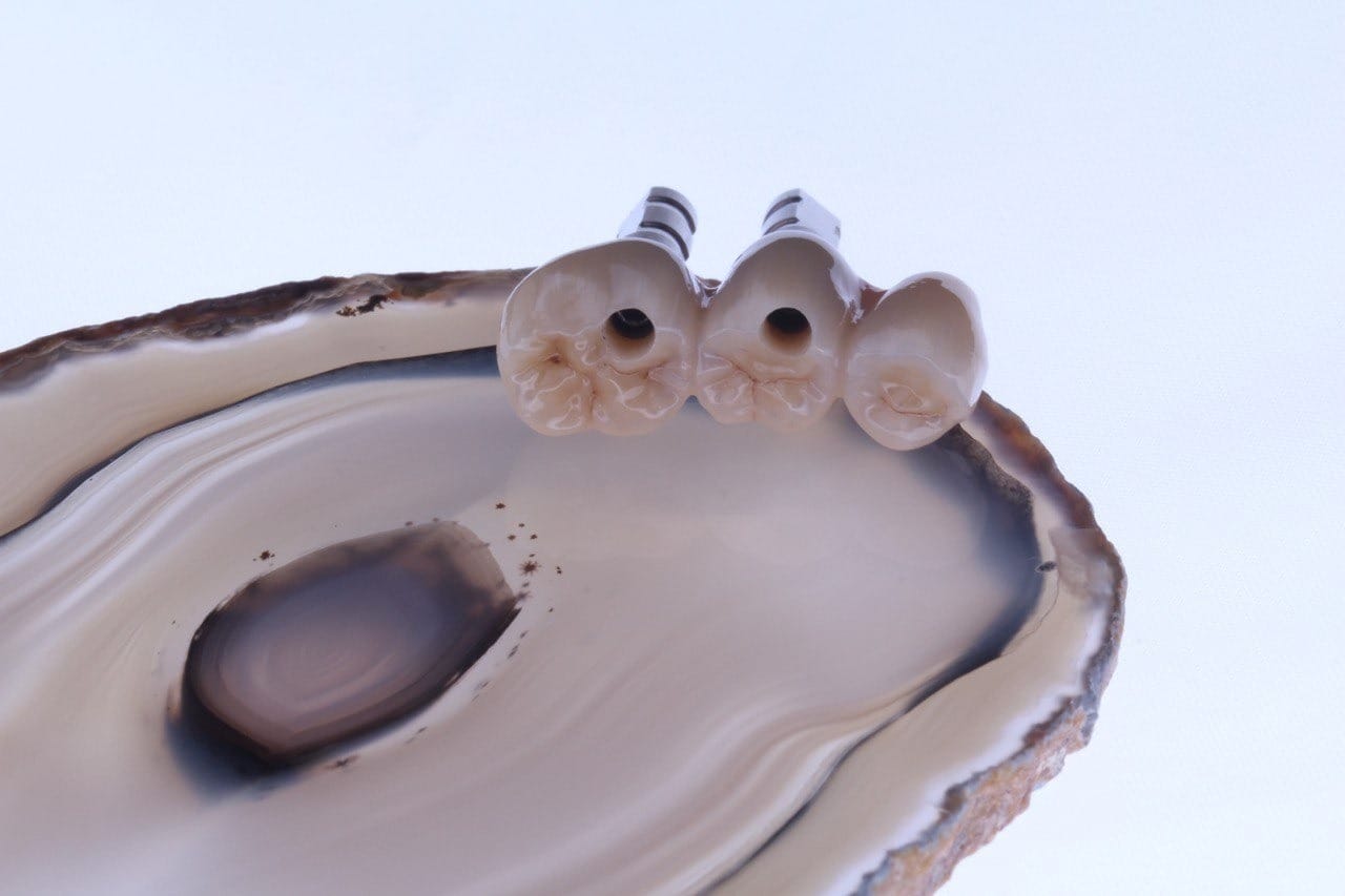 Implantatbrücke aus Vollkeramik auf Abutments