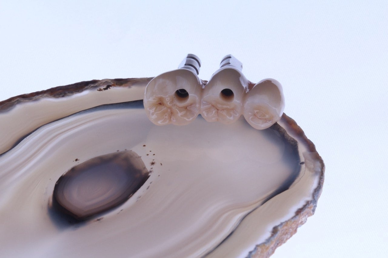 Implantatbrücke auf Abutments - Vollkeramik