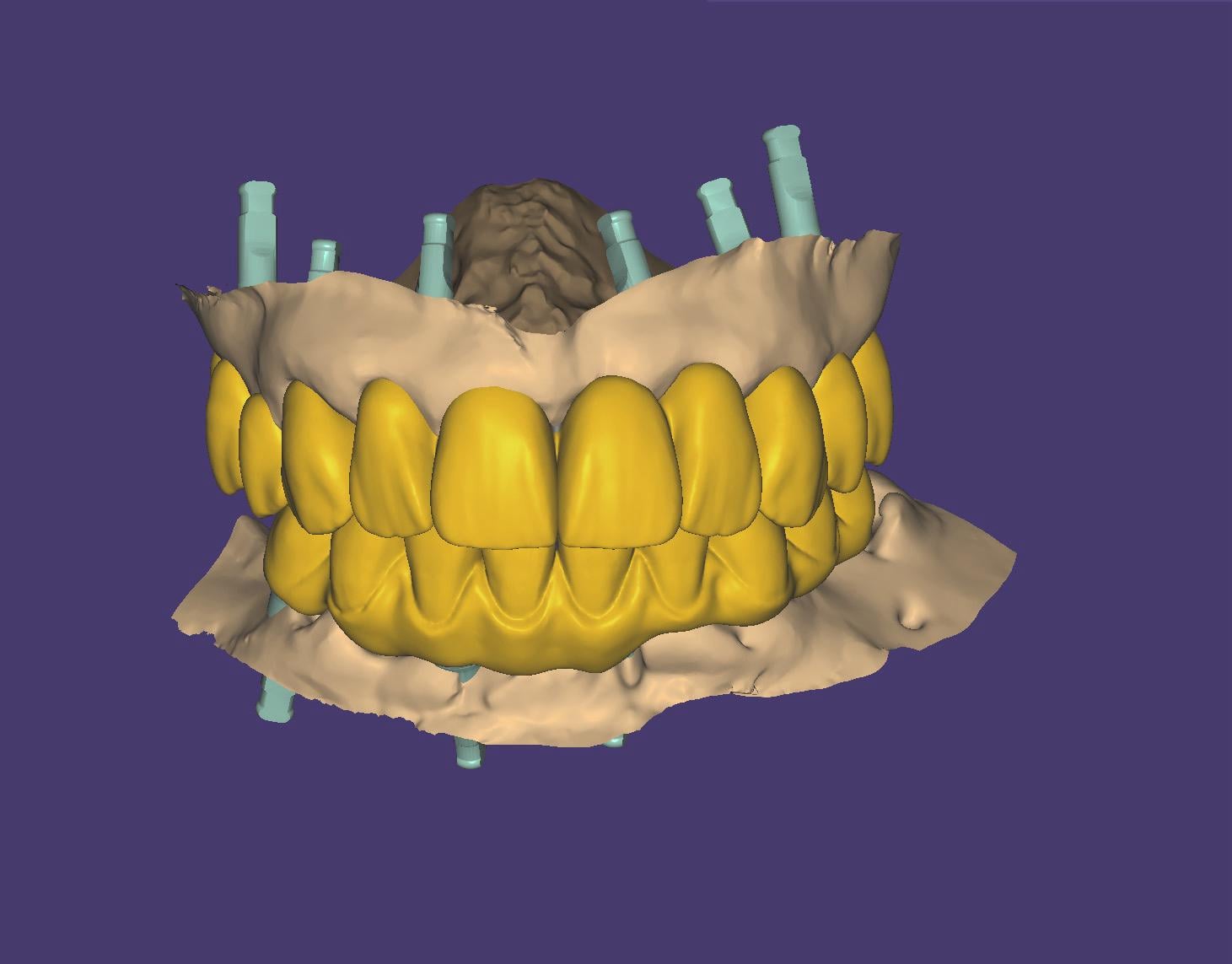 3D CAD-Planung einer Full-Arch-Versorgung