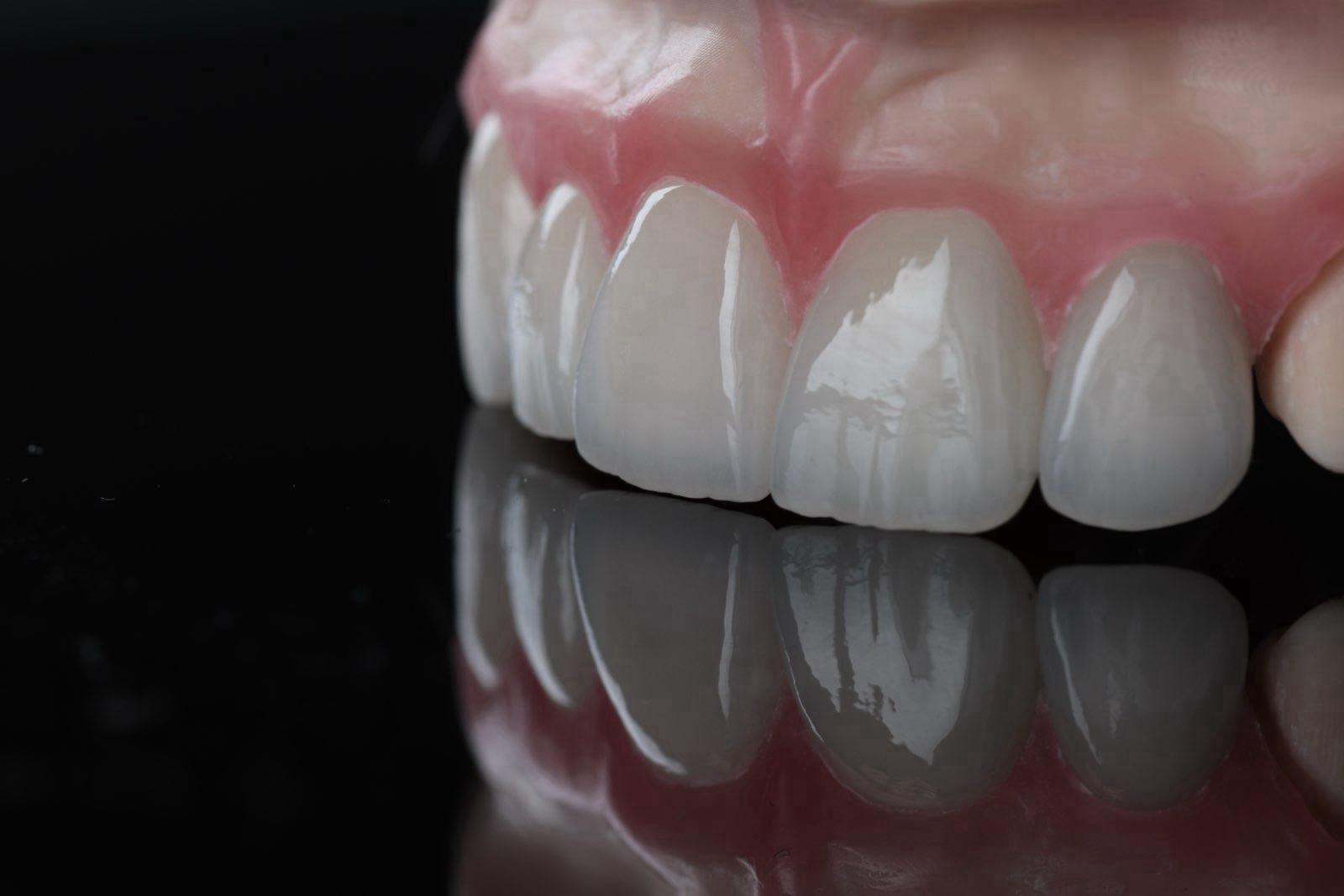 Keramikveneers im Frontzahnbereich mit Spiegelung