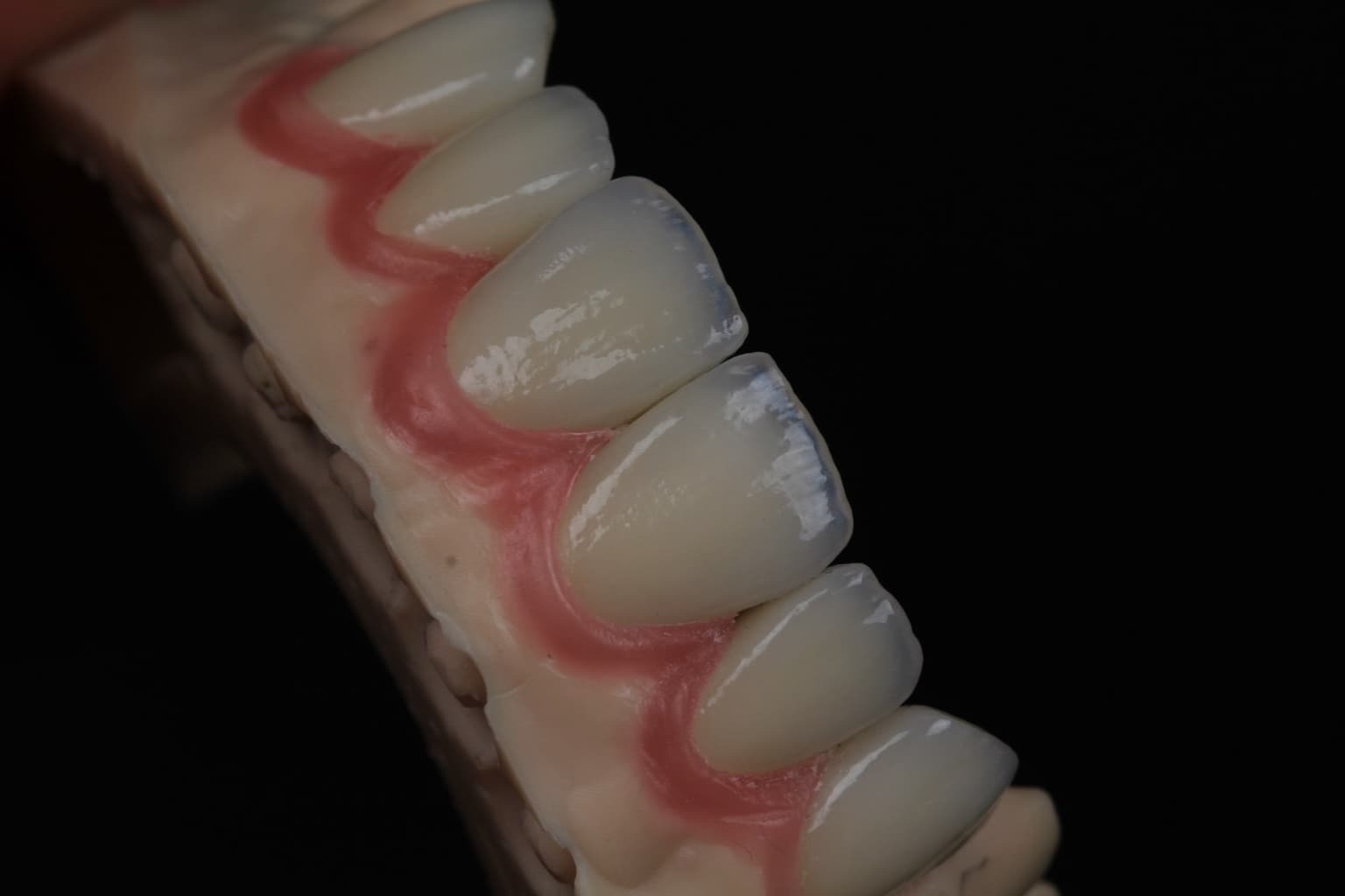 Veneers on the model, side close-up